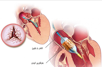 تنگی دریچه‌ی آئورت چیست؟
